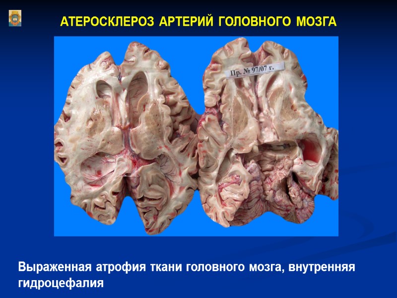 АТЕРОСКЛЕРОЗ АРТЕРИЙ ГОЛОВНОГО МОЗГА Выраженная атрофия ткани головного мозга, внутренняя гидроцефалия